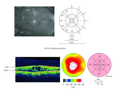 macular edema retinal thickness measurement|macular thickness scan results.